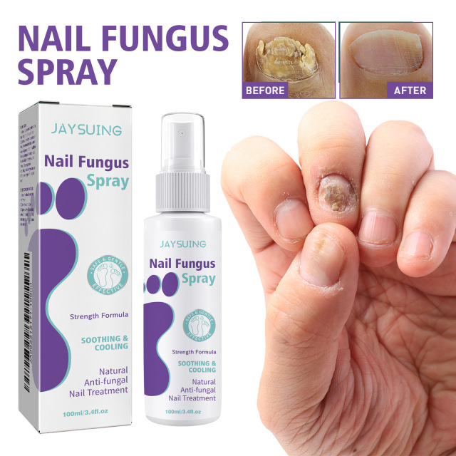 Jaysuing Onychomycosis Care Spray