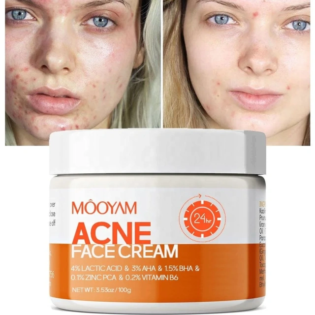 Custom Logo Skin Acne Removal Cream Facial Cream Private Label Natural Acne Face Cream