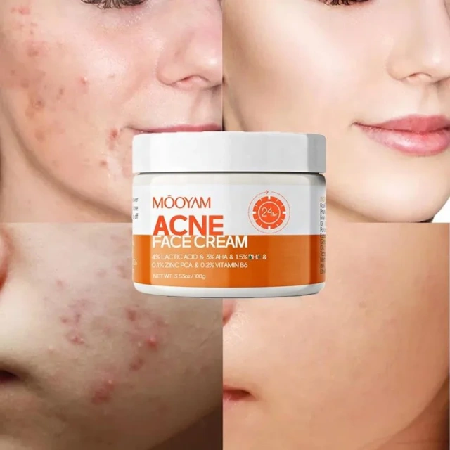 Custom Logo Skin Acne Removal Cream Facial Cream Private Label Natural Acne Face Cream