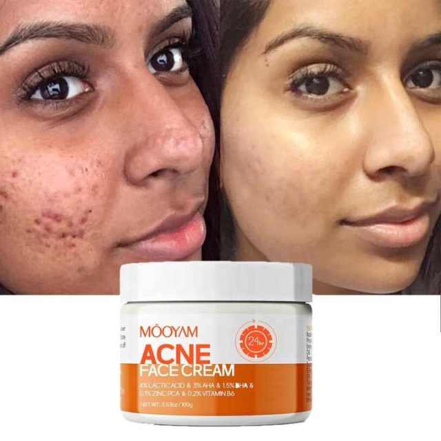 Custom Logo Skin Acne Removal Cream Facial Cream Private Label Natural Acne Face Cream