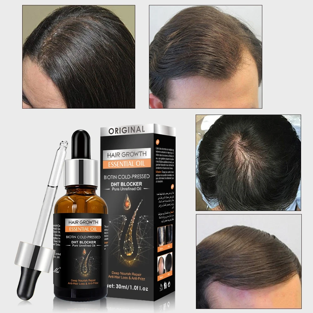 New Original Anti Hair Loss Treatment Fast Hair Growth Serum for Damage Hair