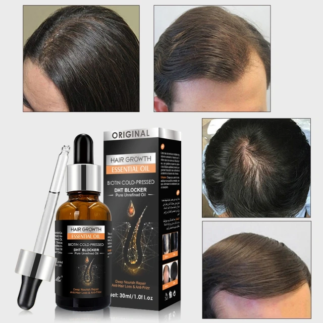 New Original Anti Hair Loss Treatment Fast Hair Growth Serum for Damage Hair