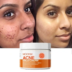 Custom Logo Skin Acne Removal Cream Facial Cream Private Label Natural Acne Face Cream