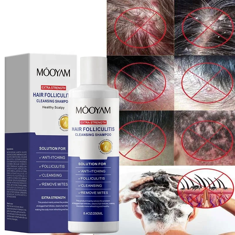 Private Label Folliculitis Shampoo Seborrheic Dermatitis Shampoo, Antifungal Scalp Psoriasis Folliculitis Treatment Shampoo