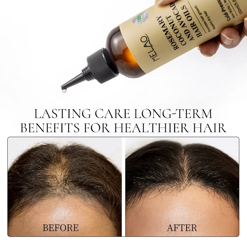 Rosemary Essential Hair Loss Oil Growth Oil Hair Strengthening Dandruff Itchy Deep Rosemary Coconut Avocado Hair Oil