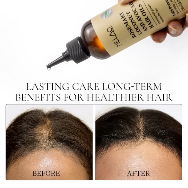Rosemary Essential Hair Loss Oil Growth Oil Hair Strengthening Dandruff Itchy Deep Rosemary Coconut Avocado Hair Oil