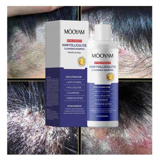 Private Label Folliculitis Shampoo Seborrheic Dermatitis Shampoo, Antifungal Scalp Psoriasis Folliculitis Treatment Shampoo