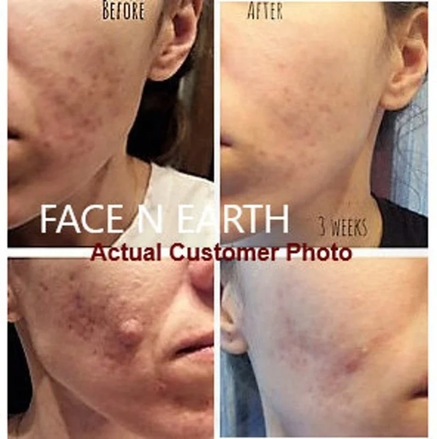 Custom Logo Skin Acne Removal Cream Facial Cream Private Label Natural Acne Face Cream