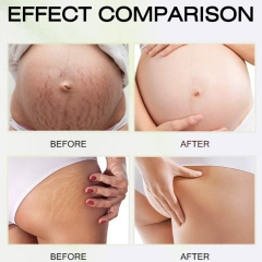 High Quality Stretch Marks Remover Skin Repair Cream Treatment Scar Removal Pregnancy Cream