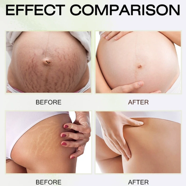 High Quality Stretch Marks Remover Skin Repair Cream Treatment Scar Removal Pregnancy Cream
