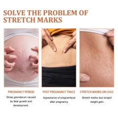 Best Selling Vegan Frmula Mild and Non-Irritating Fast Acting Smooth Skin Stretch Mark Repair Cream