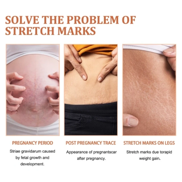 Best Selling Vegan Frmula Mild and Non-Irritating Fast Acting Smooth Skin Stretch Mark Repair Cream