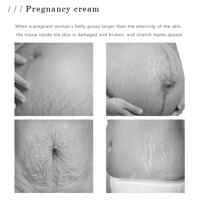 Private Label Skin Care Products Massage Repair Remover Cream Strong Effective Scar Stretch Mark Cream