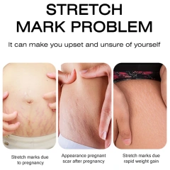 High Quality Stretch Marks Remover Skin Repair Cream Treatment Scar Removal Pregnancy Cream