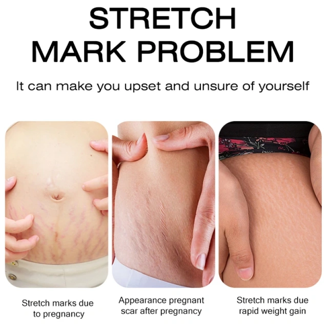 High Quality Stretch Marks Remover Skin Repair Cream Treatment Scar Removal Pregnancy Cream