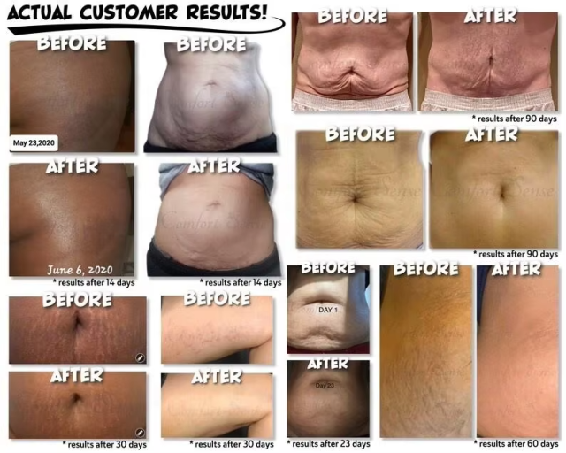 Private Label Organic Body Cellulite and Stretch Mark Cream Tummy Tuck Tightening Stretch Mark Removal Cream