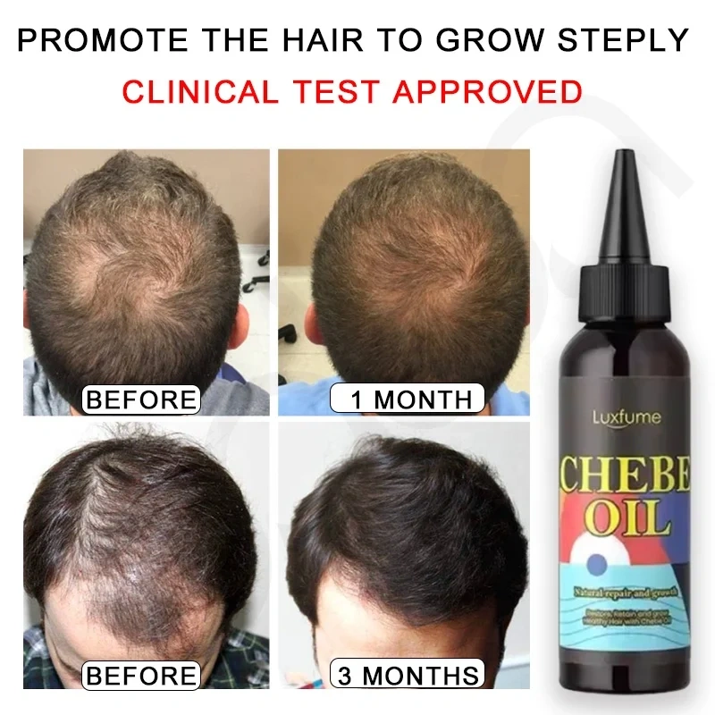Oalen Wholesale Natural and Pure Nourishing Dry Scalp Fast Hair Growth Oil Chebe Hair Oil Products