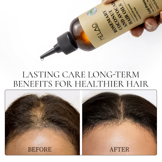Non Greasy 3-In-1 Rosemary Oil Scalp & Hair Strengthening 100% Pure Natural Rosemary Oil Hair Growth