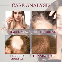 Natural Organic Scalp Vegan Red Onion Extract Hair Regrowth Essential Oil Damaged Hair  Loss Treatment Hair Care Oil