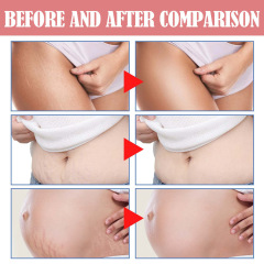 Hot Sale Vegan Stretch Marks Removal Cream Postpartum Body Care Repair Firming Stretch Marks Cream