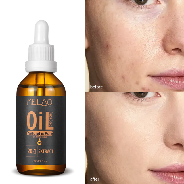 Natural Thymoquinone Body Repair Damage Skin Care Black Cumin Seed Oil Dry and Frizzy Hair Essential Oil Black Seed Oil