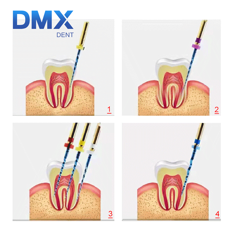 DMXDENT PT-BLUE Dental Heat Activated Niti Endodontic Root Canal Files Mixed 21mm/25MM