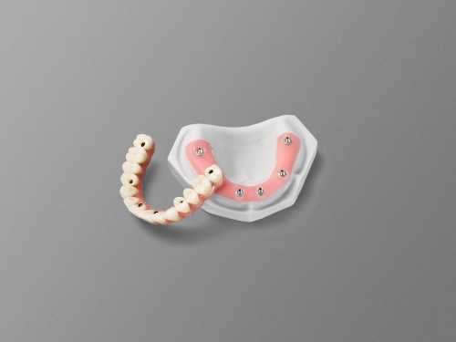 All on 6 Dental Implants | SUNRISE丨Reliable Solution for Full Mouth Rehabilitation