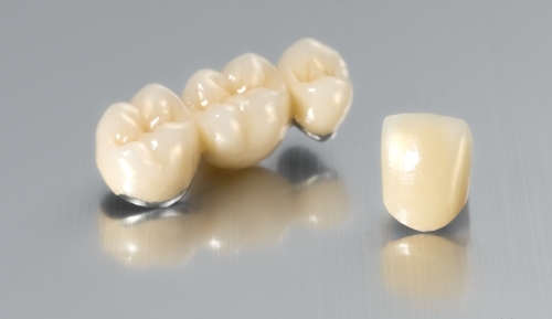 Porcelain Fused to Metal (PFM) Bridge Crown Wholesale Supplier | SUNRISE