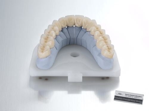 Porcelain Fused to Metal Bridge
