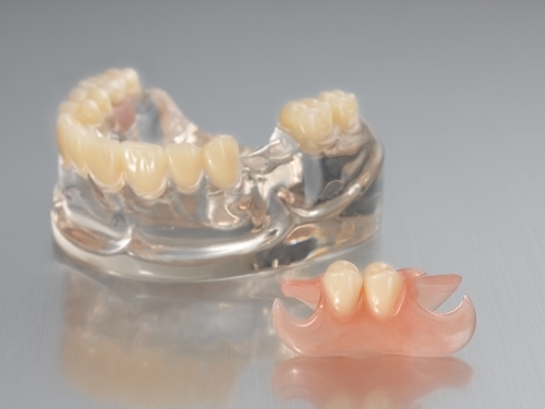 One-Side Valplast Denture (SUNRISE)丨Flexible Denture for Dental Manufacturers & Denture Suppliers