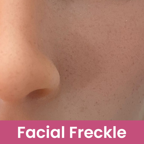  Face Freckles