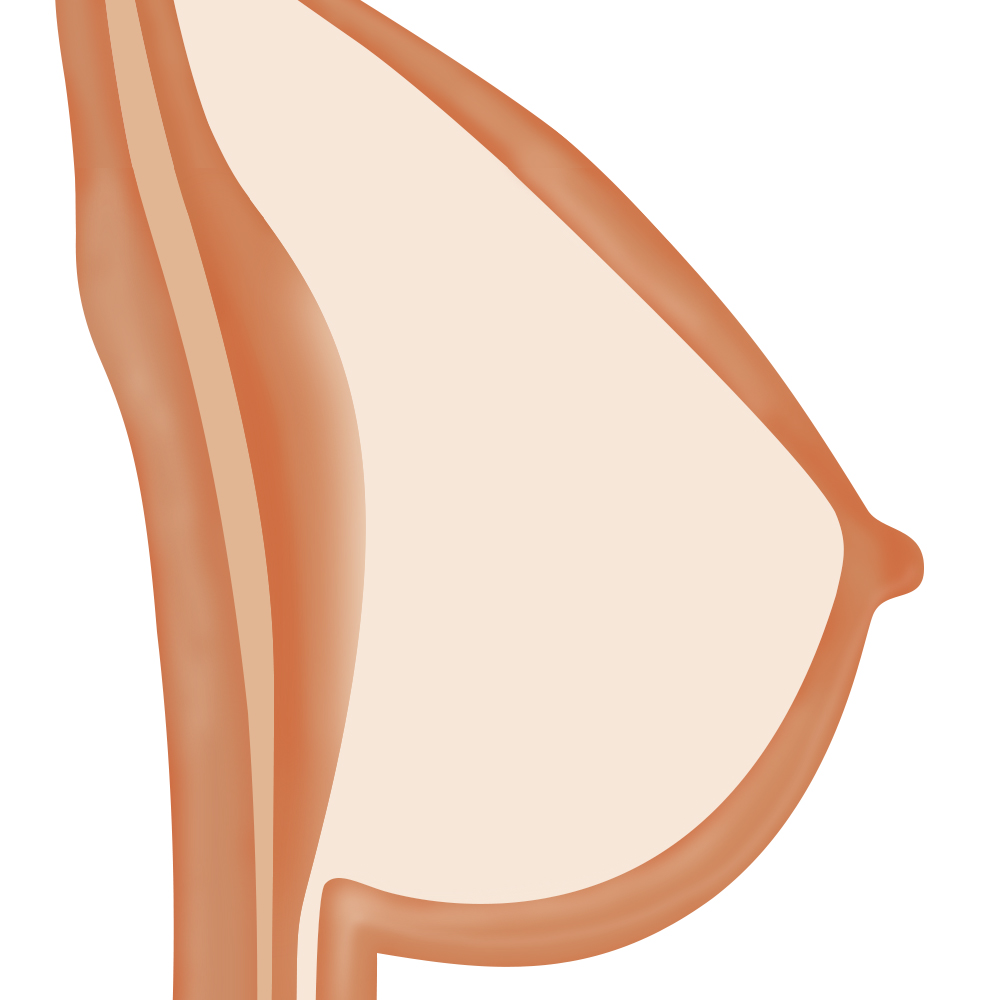 Solid Breast