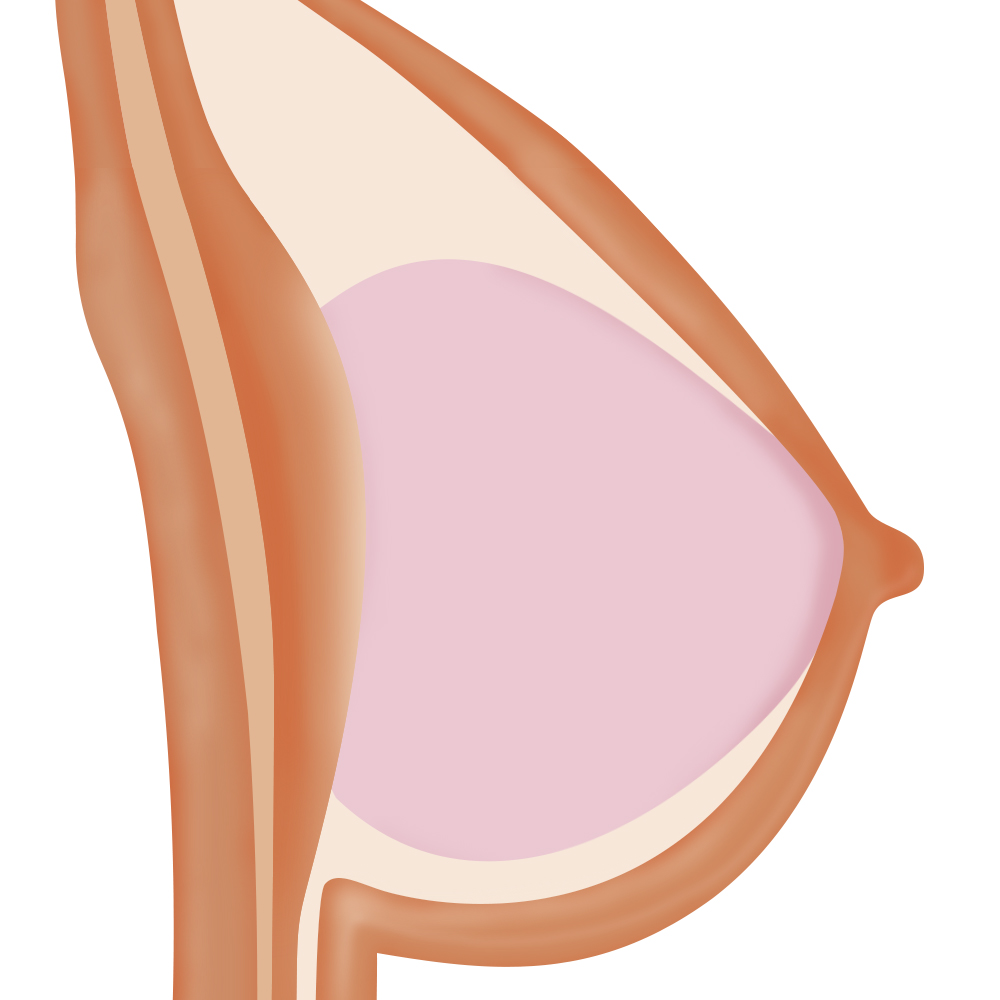 Gel Breast
