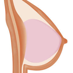 Gel Breast