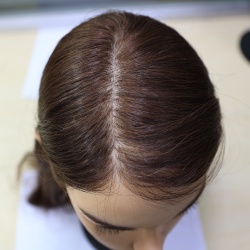 Implanted Hair