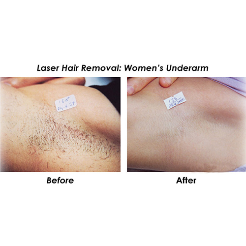 Professional Diode Laser 808nm hair removal machine