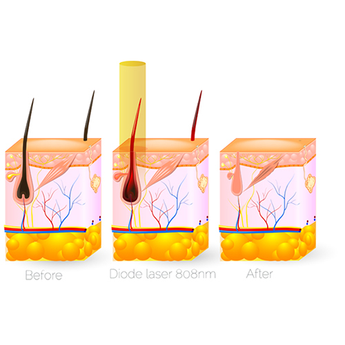 808nm Dioder laser hair removal machine