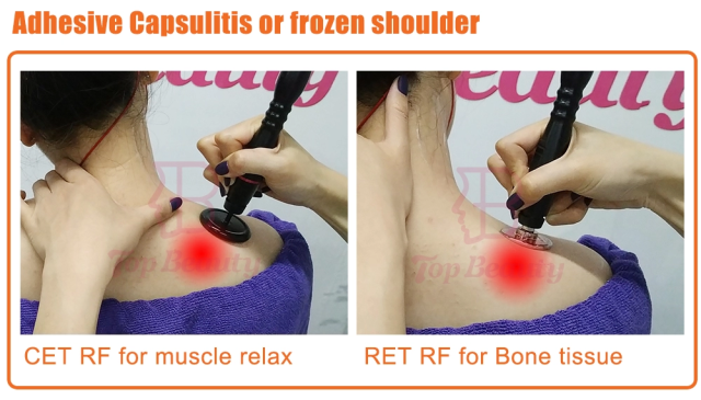 Tecar Therapy Physio Monopolar RF Resistive and Capacitive Machine Tecarterapia Profesional