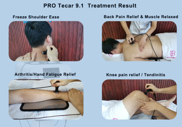 Tecar Back Knee Shoulder Pain Physiotherapy RET CET RF Monopolar tecarterapia pelvic floor tecarterapia machine