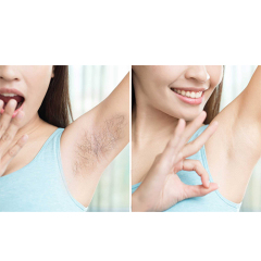 808nm Dioder laser hair removal machine