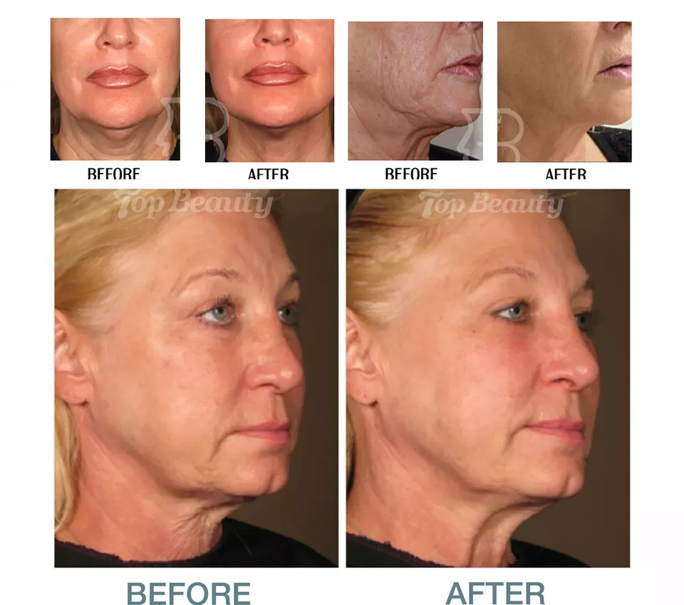 360 ° rotate display ultrasound skin rejuvenation Wrinkle Removal vertical 4D MMFU Machine