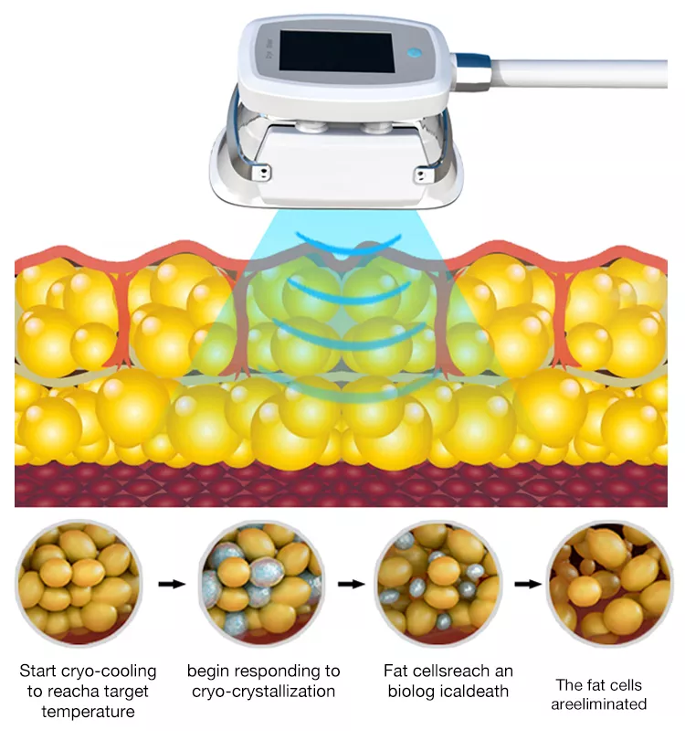 2022 360 Cryo Machine Cryolipolysis Best Price Fat Freezing Machine For Weight Loss Cryolipolysis