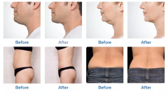 2022 360 Cryo Machine Cryolipolysis Best Price Fat Freezing Machine For Weight Loss Cryolipolysis