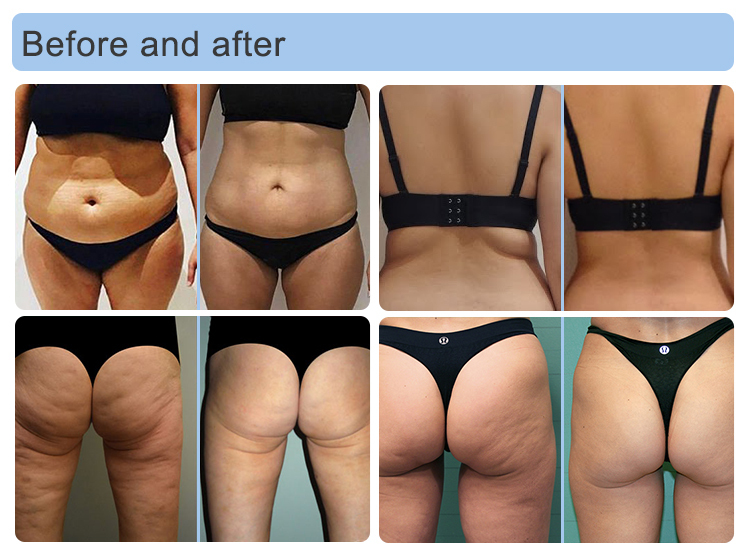 5D vacuum infrared roller cellulite reduction machine
