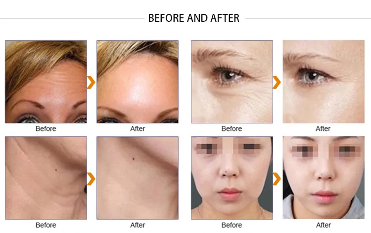 2023 New VDHF rf radio high frequency skin tightening machine best wrinkle remover equipment beauti lifting face care product