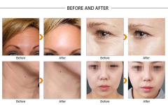 2023 New VDHF rf radio high frequency skin tightening machine best wrinkle remover equipment beauti lifting face care product