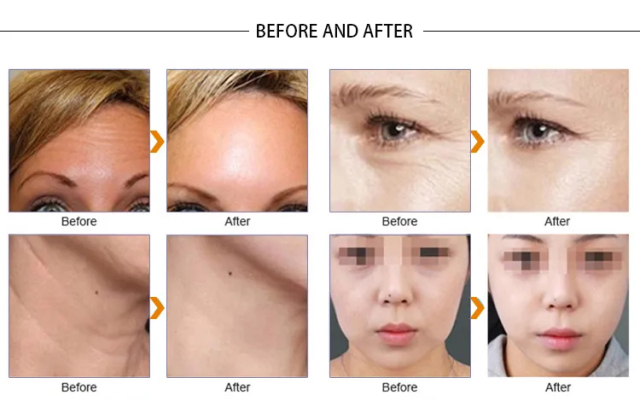 2023 New VDHF rf radio high frequency skin tightening machine best wrinkle remover equipment beauti lifting face care product