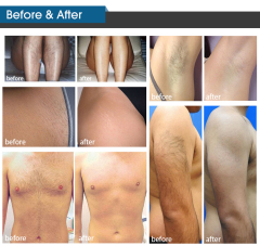 808nm Dioder laser hair removal machine