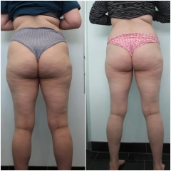 Body Shaping Endosphere Lymphatic Drainage Machine Inner Ball Roller Muscle Massage Cellulite Reduction Slimming Equipment