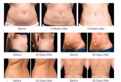 Best price cryolipolysis slimming machine cryotherapy weight lose fat freezing